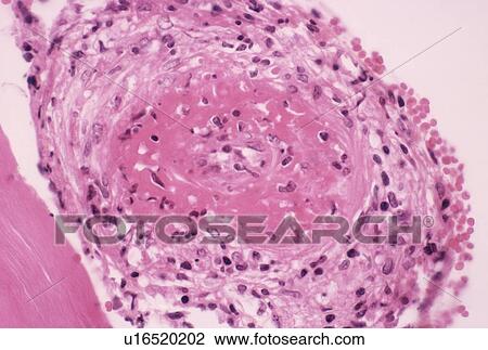 Stock Image - Blood clot. Fotosearch