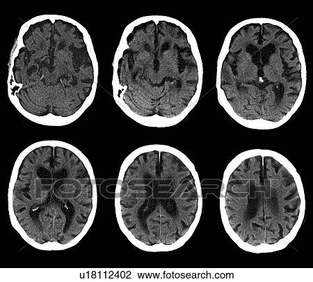 Stock Image - Brain with Alzheimer's disease, CT scan. Fotosearch