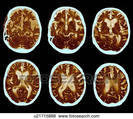 Brain with Alzheimer's disease, CT scan View Large Photo Image Stock Photo - Brain with Alzheimer's disease, CT scan. Fotosearch