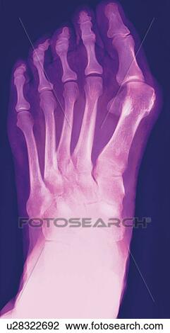 Bunion, X-ray View Large Photo Image Stock Image - Bunion, X-ray. Fotosearch