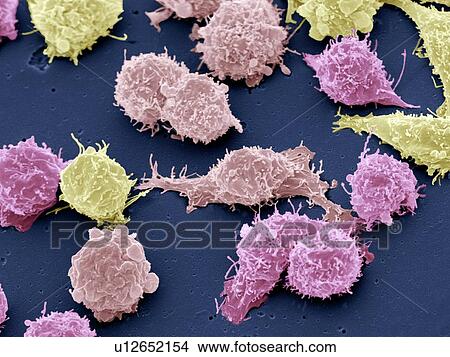 Cancer cells, SEM View Large Photo Image Picture - Cancer cells, SEM. Fotosearch