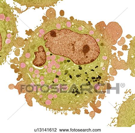 Stock Image - Carcinoma cell, TEM. Fotosearch