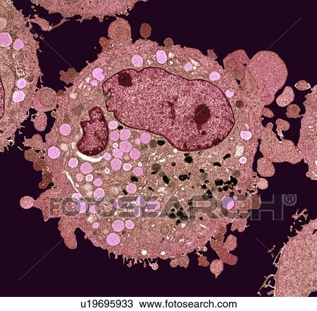 Stock Image - Carcinoma cell, TEM. Fotosearch