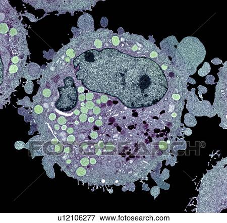 Stock Photo - Carcinoma cell, TEM. Fotosearch