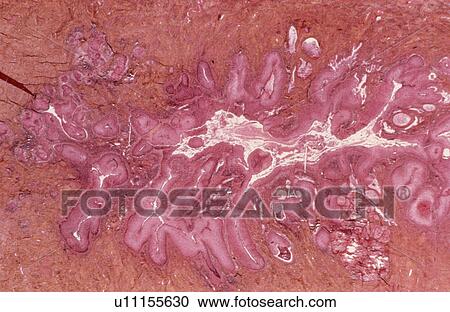 Cervical cancer View Large Photo Image Stock Image - Cervical cancer. Fotosearch
