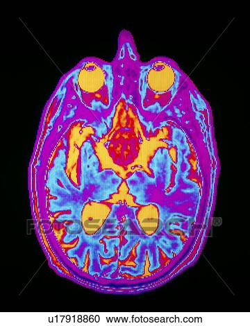 Coloured MRI brain scan: pituitary adenoma View Large Photo Image Stock Image - Coloured MRI brain scan: pituitary adenoma. Fotosearch