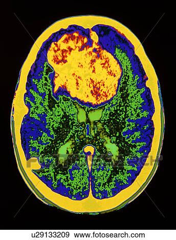 Coloured MRI brain scan showing a meningioma View Large Photo Image Stock Photo - Coloured MRI brain scan showing a meningioma. Fotosearch