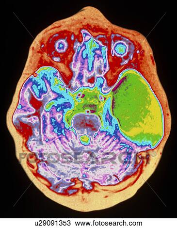 Stock Image - Coloured MRI brain scan showing an arachnoid cyst. Fotosearch
