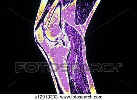 Coloured MRI of a section through a knee joint View Large Photo Image Stock Image - Coloured MRI of a section through a knee joint. Fotosearch