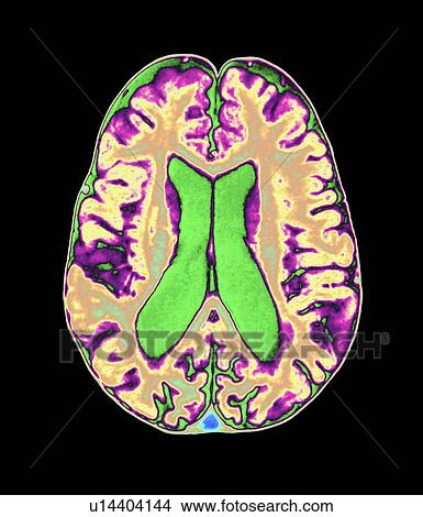 Coloured MRI scan of organophosphate brain damage View Large Photo Image Picture - Coloured MRI scan of organophosphate brain damage. Fotosearch