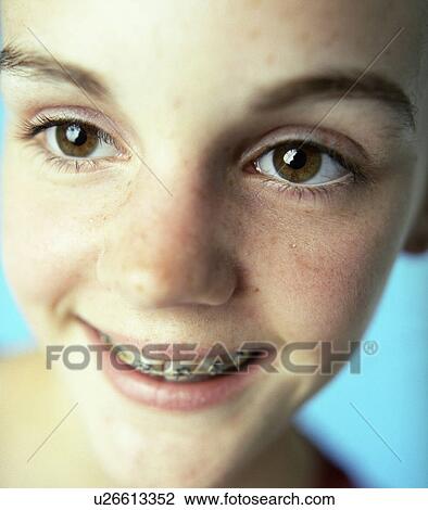 Dental braces View Large Photo Image Stock Image - Dental braces. Fotosearch