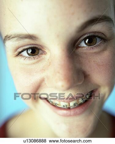 Stock Photo - Dental braces. Fotosearch