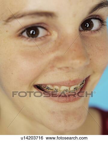 Stock Photograph - Dental braces. Fotosearch