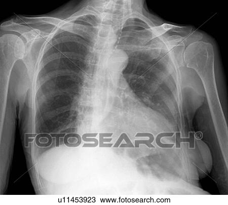 Stock Image - Enlarged heart, X-ray. Fotosearch
