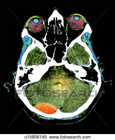 Stock Photography - Extradural haematoma, CT scan. Fotosearch