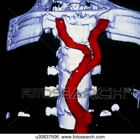 False-colour 3-D CT image of abdominal aorta View Large Photo Image Stock Photograph - False-colour 3-D CT image of abdominal aorta. Fotosearch