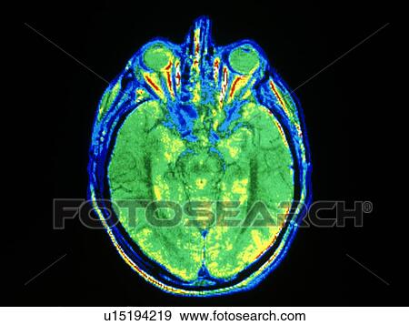 Stock Photo - False-colour MRI scan of the head, axial section. Fotosearch