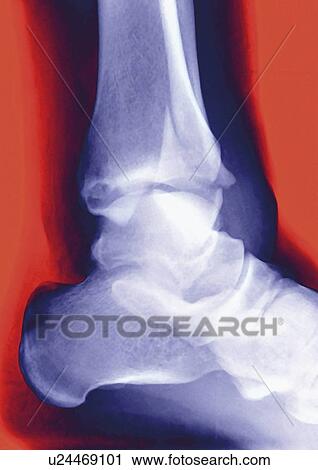 Stock Image - Fractured ankle, X-ray. Fotosearch