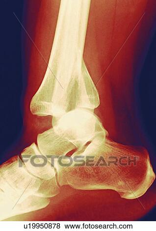 Stock Photo - Fractured ankle, X-ray. Fotosearch