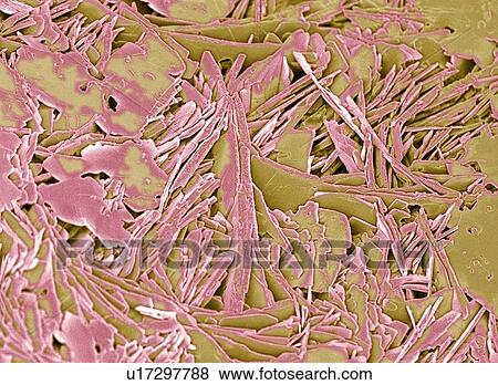 Gallstone, SEM View Large Photo Image Stock Photo - Gallstone, SEM. Fotosearch