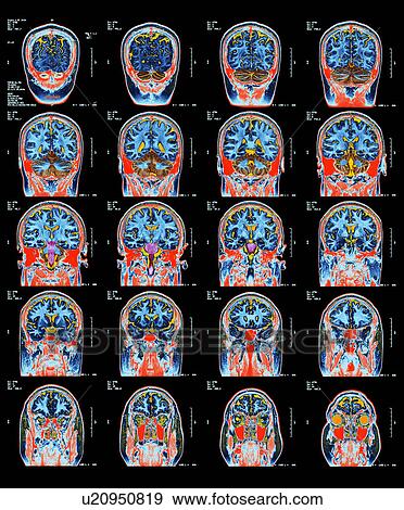 Healthy brain, MRI scans View Large Photo Image Stock Photo - Healthy brain, MRI scans. Fotosearch