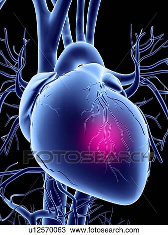Stock Image - Heart attack, conceptual artwork. Fotosearch