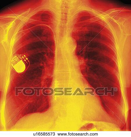 Heart pacemaker, X-ray View Large Photo Image Stock Image - Heart pacemaker, X-ray. Fotosearch