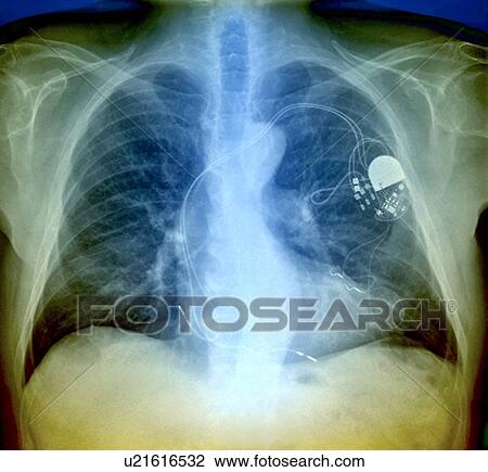 Stock Image - Heart pacemaker, X-ray. Fotosearch