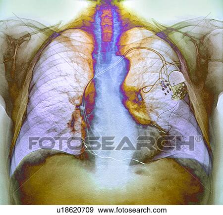 Heart pacemaker, X-ray View Large Photo Image Stock Photo - Heart pacemaker, X-ray. Fotosearch