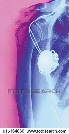 Stock Photograph - Heart pacemaker, X-ray. Fotosearch
