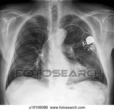 Stock Photograph - Heart pacemaker, X-ray. Fotosearch