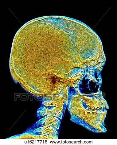 Human skull, X-ray View Large Photo Image Stock Photograph - Human skull, X-ray. Fotosearch