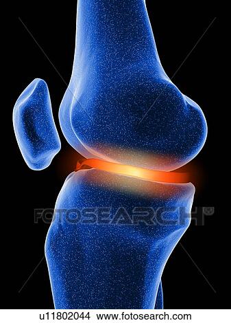 Inflamed knee cartilage, computer artwork View Large Photo Image Picture - Inflamed knee cartilage, computer artwork. Fotosearch