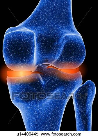 Inflamed knee cartilage, computer artwork View Large Photo Image Stock Photography - Inflamed knee cartilage, computer artwork. Fotosearch