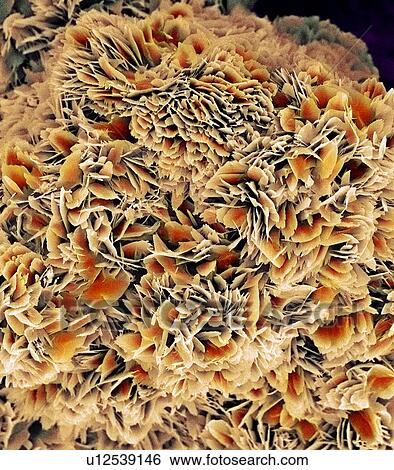 Stock Photograph - Kidney stone crystals, SEM. Fotosearch