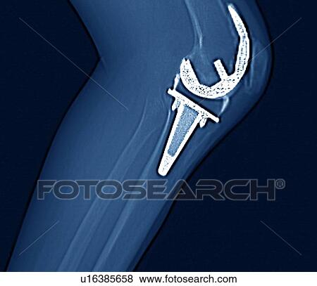 Knee replacement, CT scan View Large Photo Image Stock Photo - Knee replacement, CT scan. Fotosearch