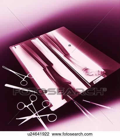 Stock Image - Leg fracture, X-ray. Fotosearch