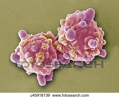 Stock Photo - Leukaemia cells, SEM. Fotosearch