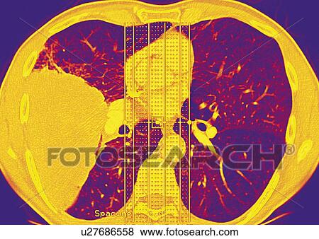 Lung cancer, CT scan View Large Photo Image Stock Photo - Lung cancer, CT scan. Fotosearch