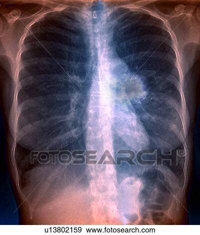 Stock Photo - Lung cancer, X-ray. Fotosearch