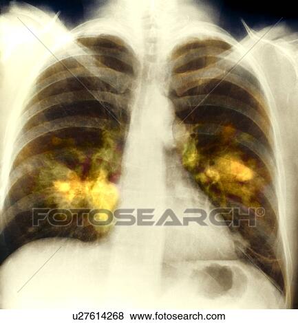 Lung cancer, X-ray View Large Photo Image Stock Photo - Lung cancer, X-ray. Fotosearch