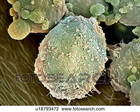 Lymphoma lymph cell, SEM View Large Photo Image Stock Image - Lymphoma lymph cell, SEM. Fotosearch