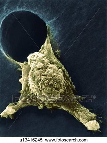 Stock Photography - Metastasis of a cancerous cell, SEM. Fotosearch