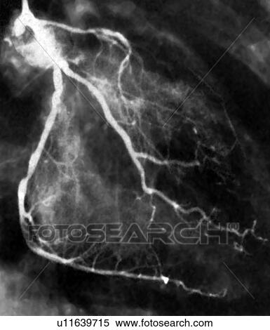 Narrowed coronary arteries, X-ray View Large Photo Image Stock Photography - Narrowed coronary arteries, X-ray. Fotosearch