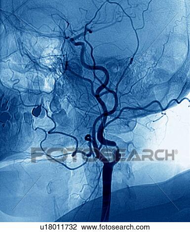 Stock Image - Narrowed neck artery, angiogram. Fotosearch