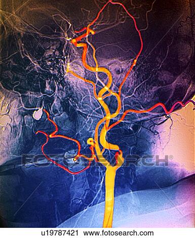 Stock Image - Narrowed neck artery, angiogram. Fotosearch