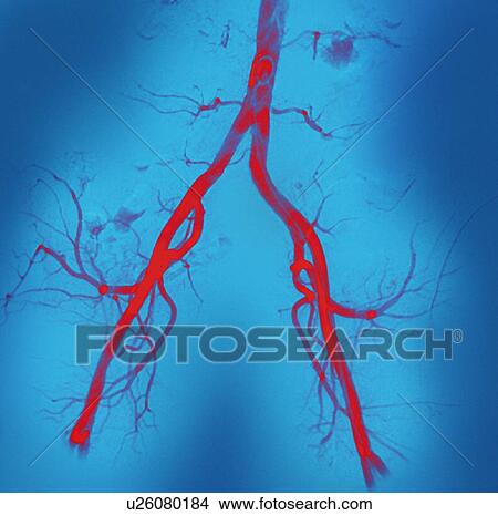Normal abdominal arteries, angiogram View Large Photo Image Picture - Normal abdominal arteries, angiogram. Fotosearch