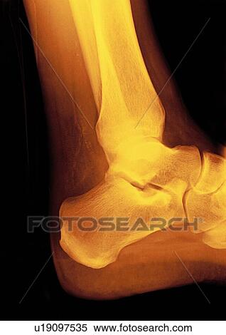 Stock Photography - Normal ankle joint, X-ray. Fotosearch
