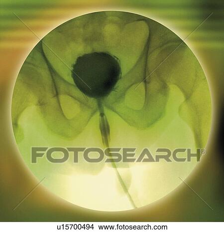 Picture - Normal bladder, cystogram. Fotosearch