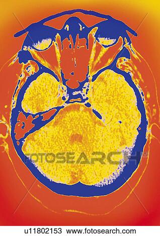 Normal brain, CT scan View Large Photo Image Stock Image - Normal brain, CT scan. Fotosearch